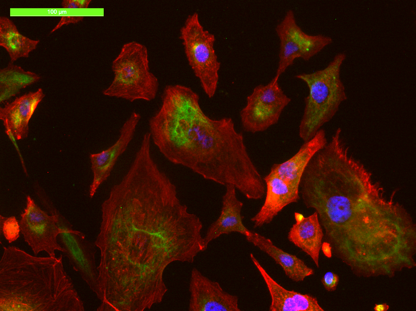 Fluorescence microscopy composite of prostate cancer cells studied at the ONCOCRISPR Lab