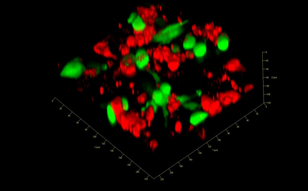 GFP-expressing PC3 prostate cancer cells migrating through a pore membrane coated with epithelial cells